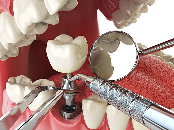 Best Emergency Dentist for Lost Fillings or Crowns in Noyack, NY